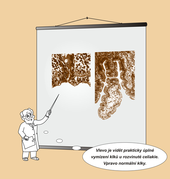 celiakie-klky