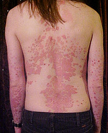 220px-Psoriasis_on_back