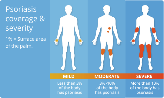 psoriasis-coverage-severity.ashx