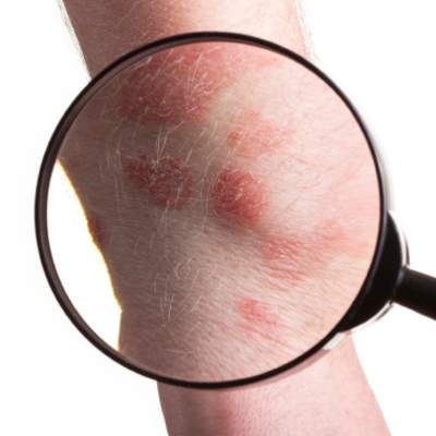 psoriasis_1